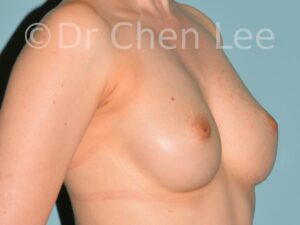 Inverted nipple surgery before after right oblique photo #05