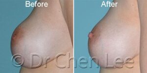 Before and After photos of inverted nipple surgery